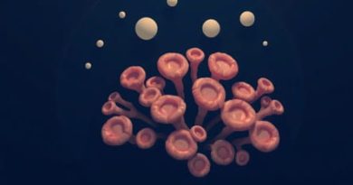 Porous Coral Like Outgrowths In The Orbits