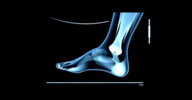 Ultrasound Therapy For Plantar Fasciitis