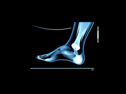 Ultrasound Therapy For Plantar Fasciitis