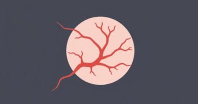 Vascular And Capsular Invasion