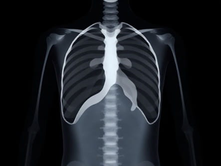 X Ray Of Congenital Diaphragmatic Hernia