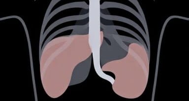 X Ray Of Pancreatic Cancer