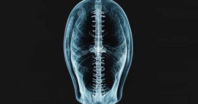 Olecranon Ossification Center Xray