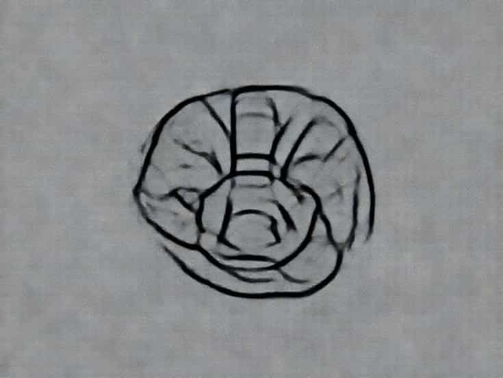 Low Grade Cartilaginous Neoplasm