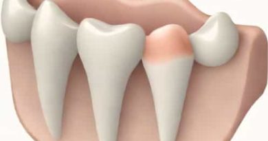 Oblique Ridge Of Maxillary Molar