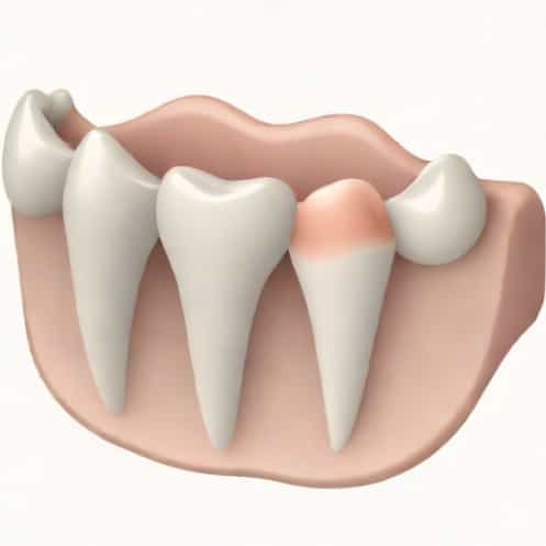 Oblique Ridge Of Maxillary Molar