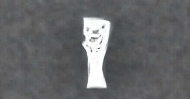 X Ray Of Healed Clavicle Fracture