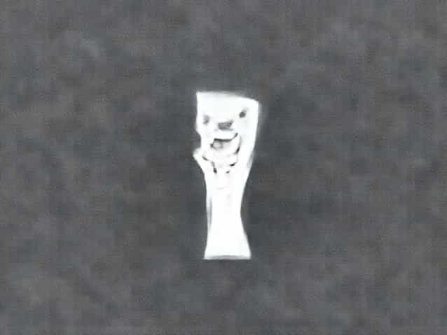 X Ray Of Healed Clavicle Fracture