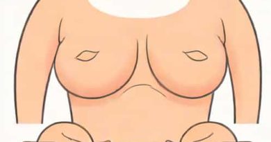 Incisions For Nipple Sparing Mastectomy