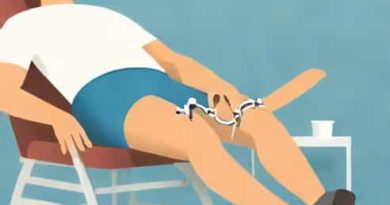 Knee Manipulation Under Anesthesia Cpt