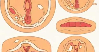 Remineralization Of Incipient Lesions