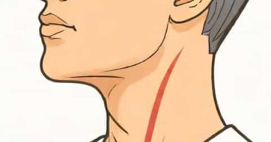 Right Side Of Neck Hurts When I Swallow